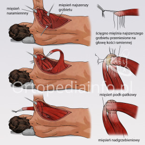 Uszkodzenie stożka rotatorów - przeszczep mięśnia najszerszego grzbietu