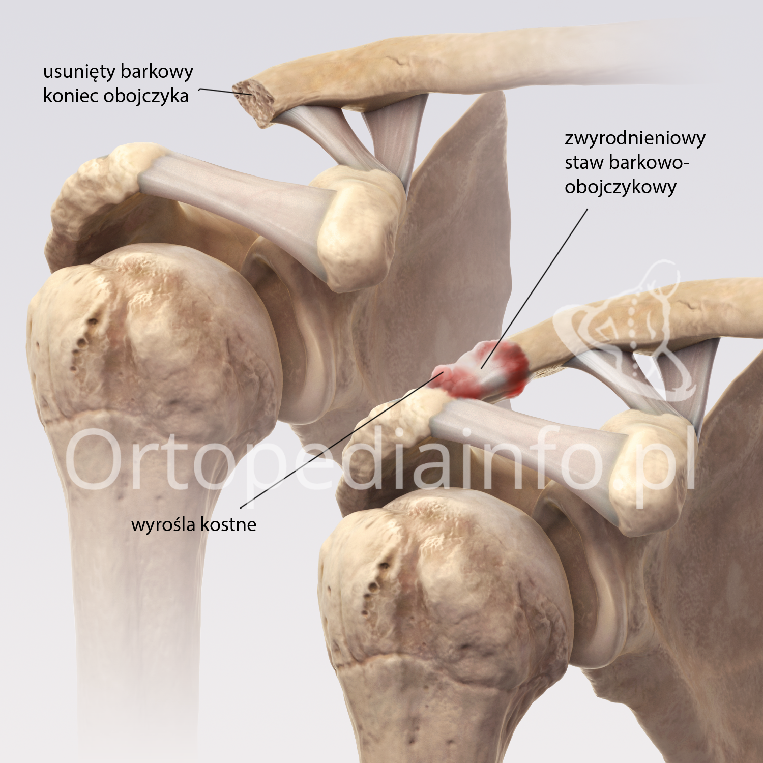 zwyrodnienie stawu barkowego ćwiczenia artroza gradului 4 al tratamentului articulației genunchiului