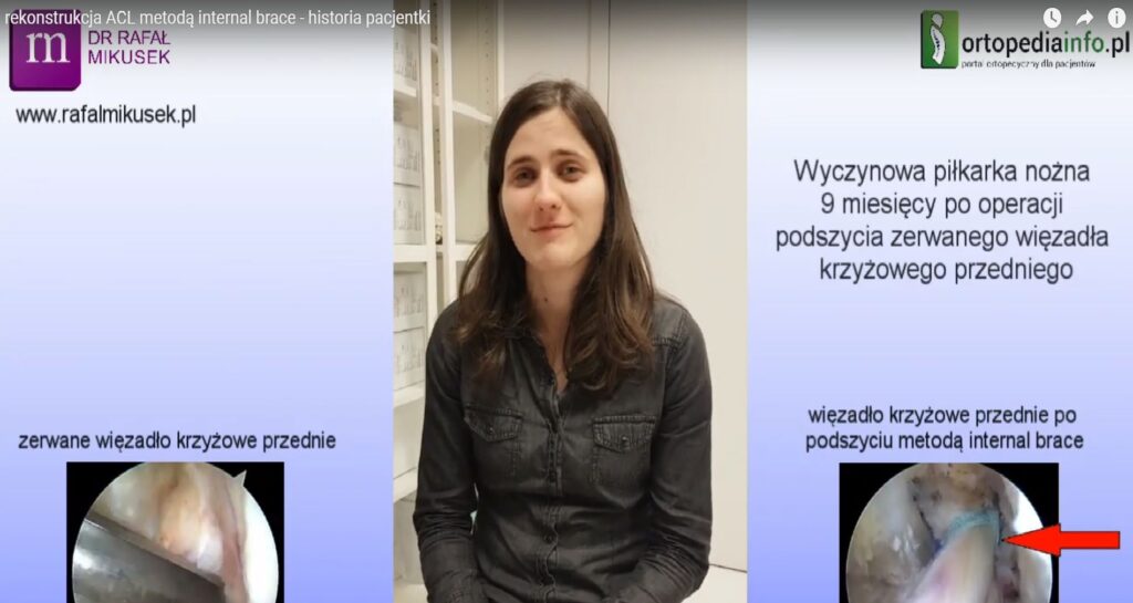 rekonstrukcja więzadła krzyżowego przedniego ACL metodą internal brace