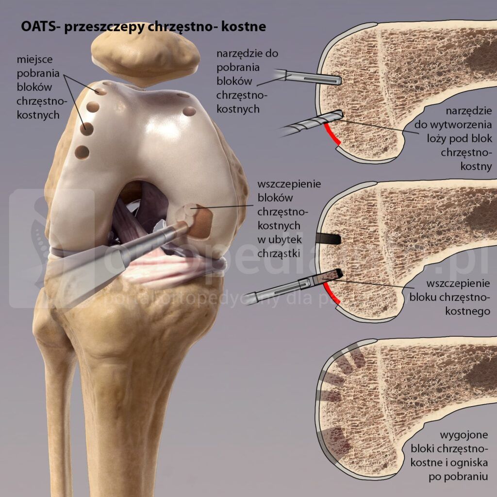 Uszkodzenie chrząstki chondromalacja - zabieg przeszczepu autologicznego mozaikowego bloków chrzęstno-kostnych (OATS) 