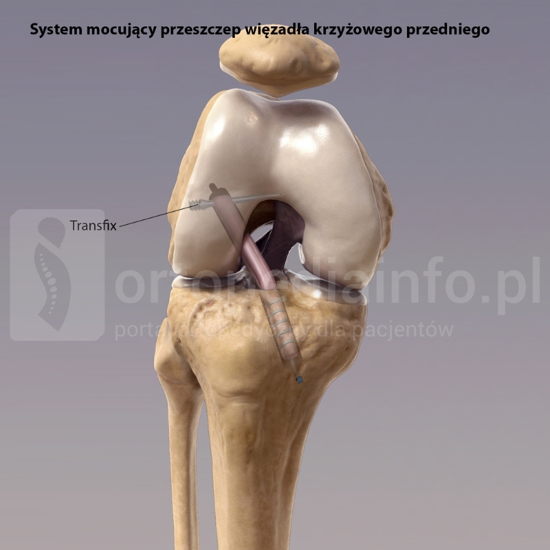 transfix mocowanie przeszczepu więzadła krzyżowego przedniego ACL