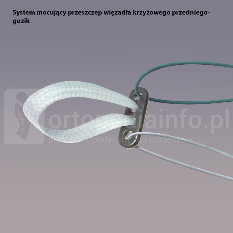 system mocujący przeszczep więzadła krzyżowego przedniego ACL