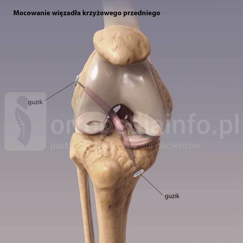 Przewlekła niestabilność więzadła krzyżowego przedniego ACL - mocowanie przeszczepu