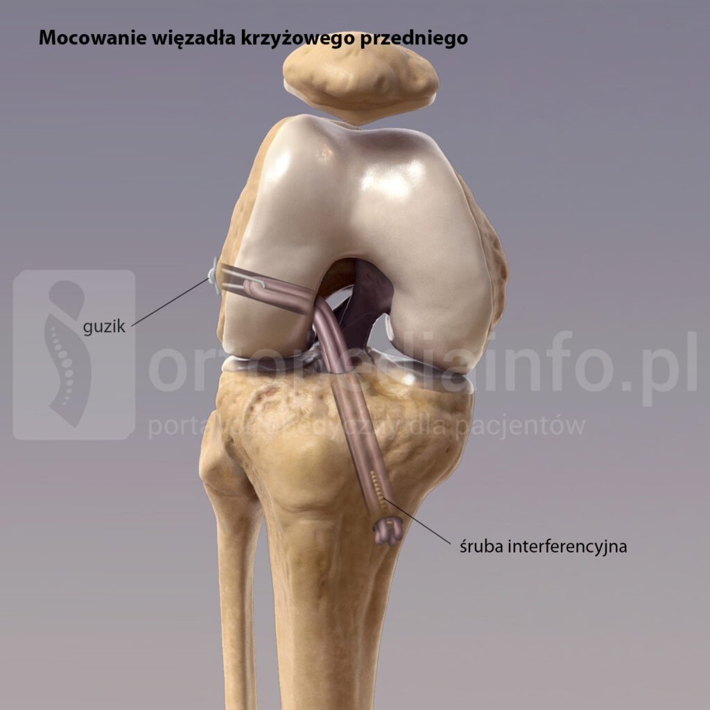 mocowanie przeszczepu ACL