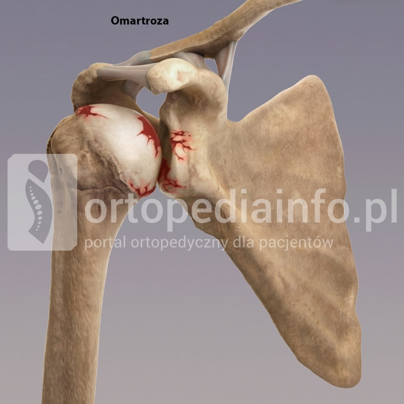 Omartroza zmiany zwyrodnieniowe stawu ramiennego