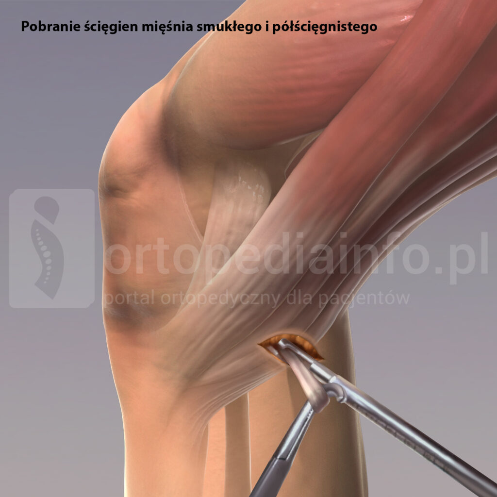 Rekonstrukcja więzadła krzyżowego przedniego ACL - autograft