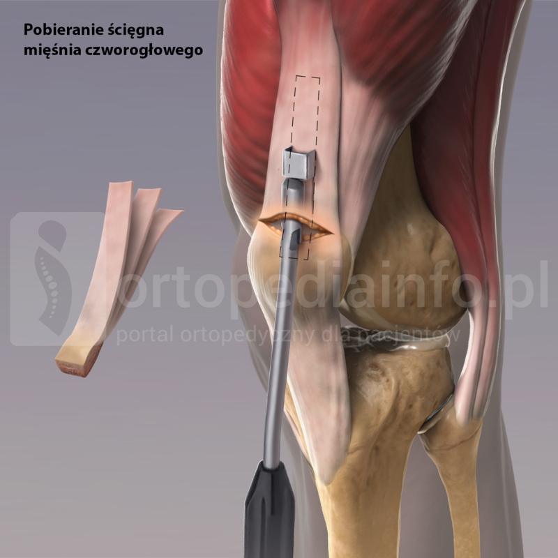 pobranie ścięgna mięśnia czworogłowego