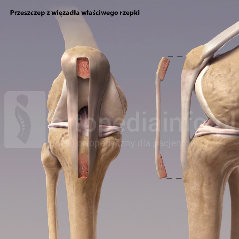 przeszczep z więzadła właściwego rzepki