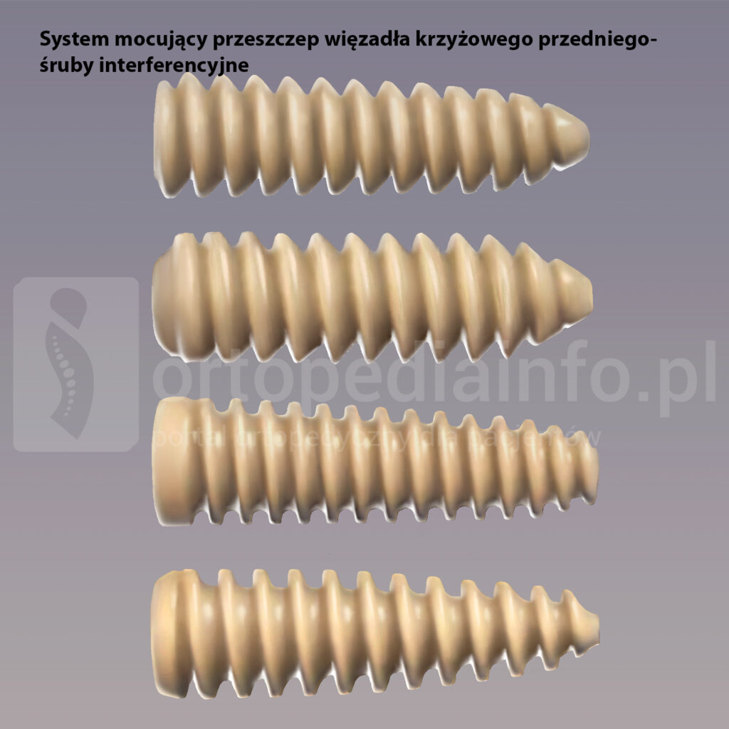 śruby interferencyjne do mocowania przeszczepu więzadła krzyżowego przedniego ACL