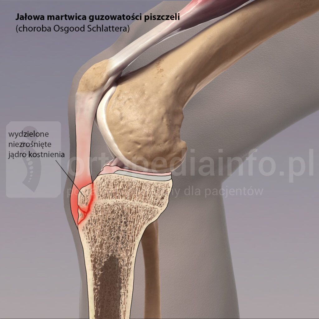 jałowa martwica guzowatości piszczeli (choroba Osgooda Schlattera)