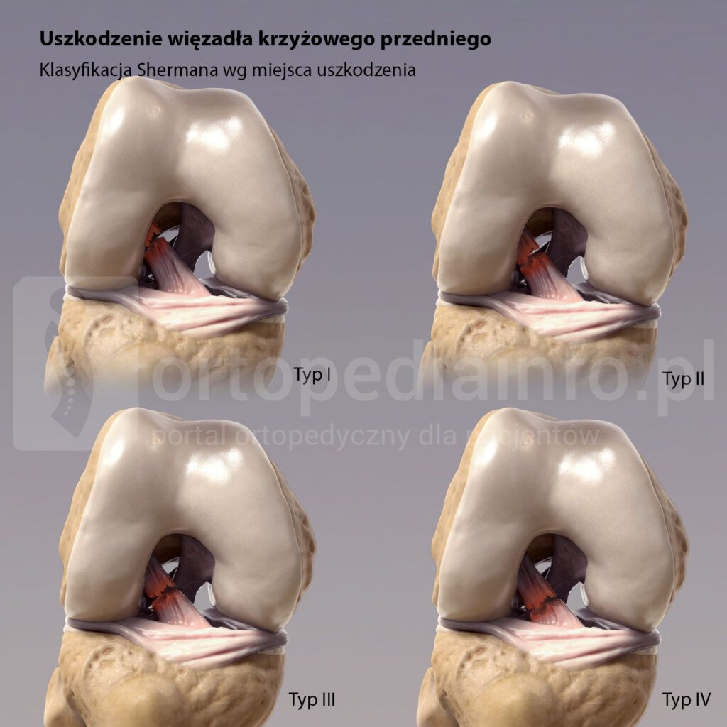 uszkodzenie więzadła krzyzowego przedniego klasyfikacja Shermana/metoda internal bracing